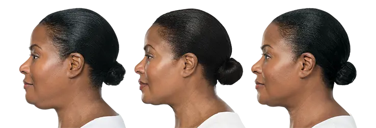 Kybella 1