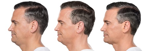 Kybella treatments