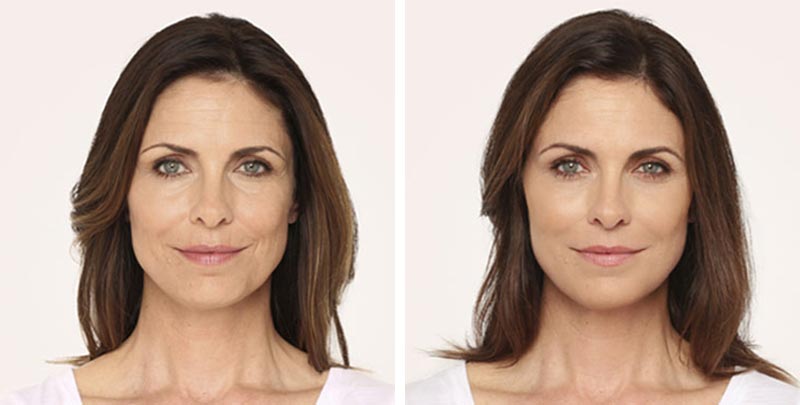 Radiesse Injections