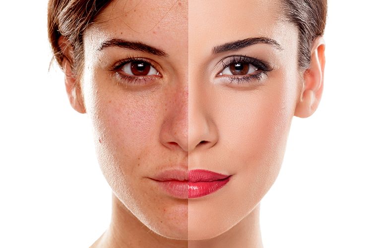 BBL Face Treatments In Pahrump