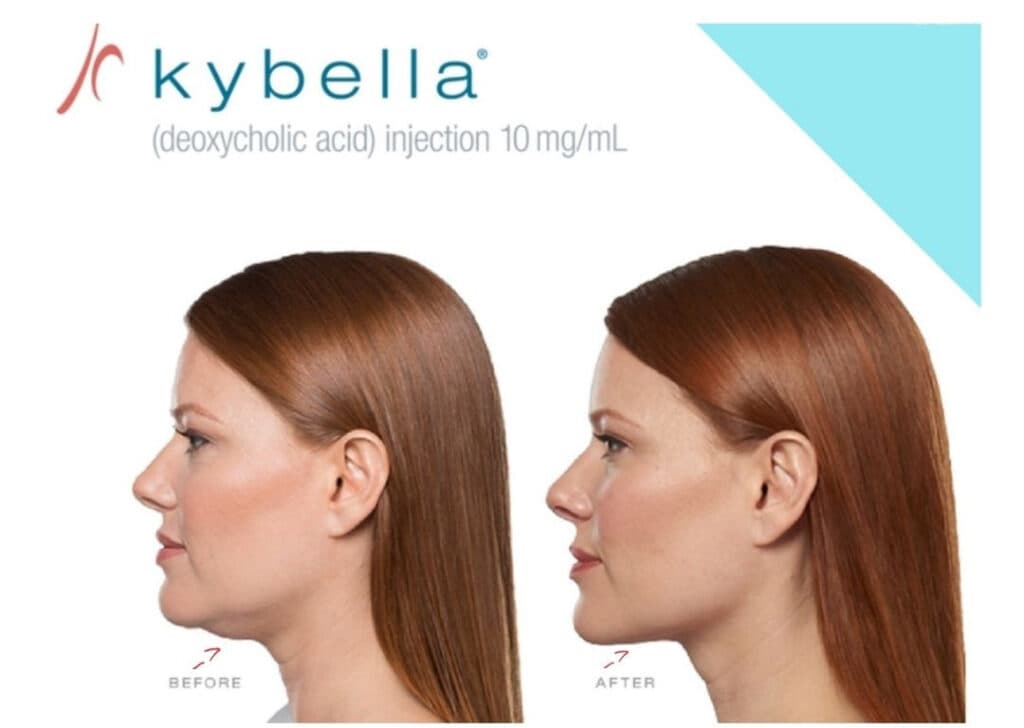 KYBELLA™ Treatment for Double Chin