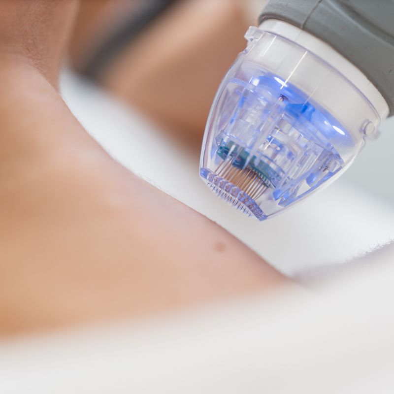 Microneedling Treatments in Pahrump