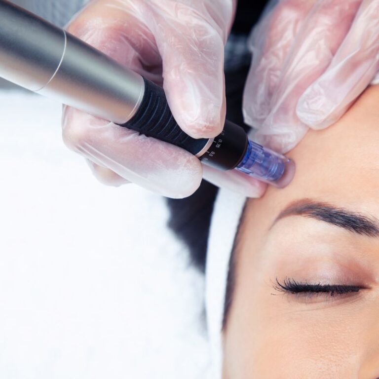 Will Microneedling Work For Me