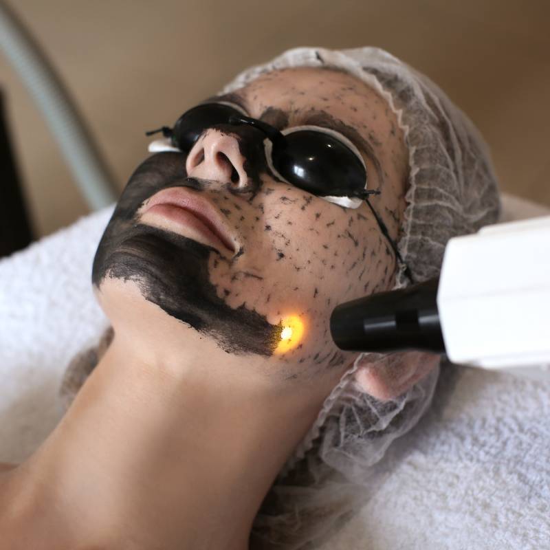 Deep Laser Peel For Wrinkles