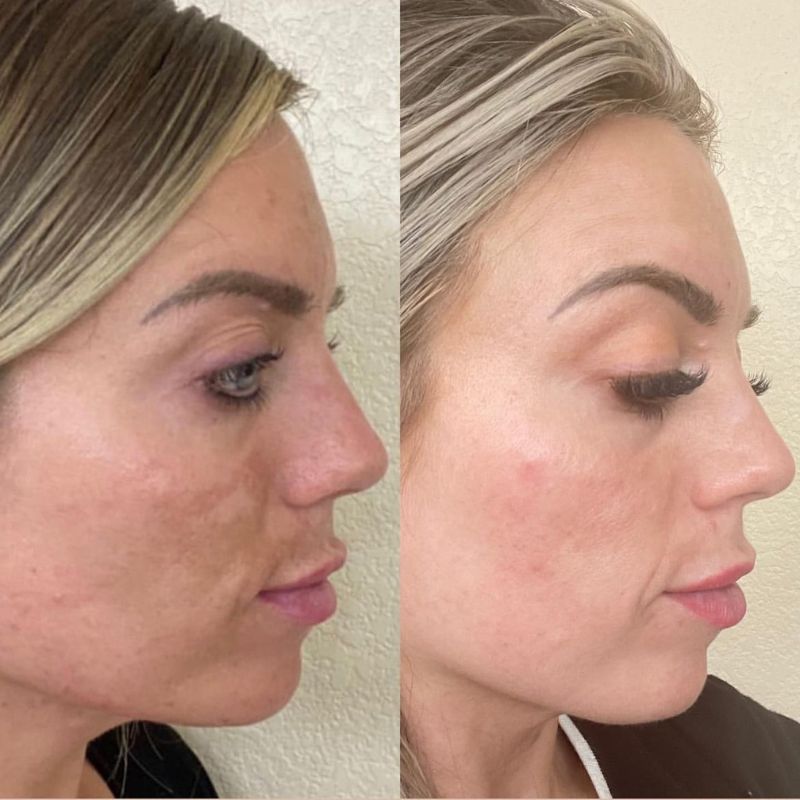 Chemical peels in Pahrump
