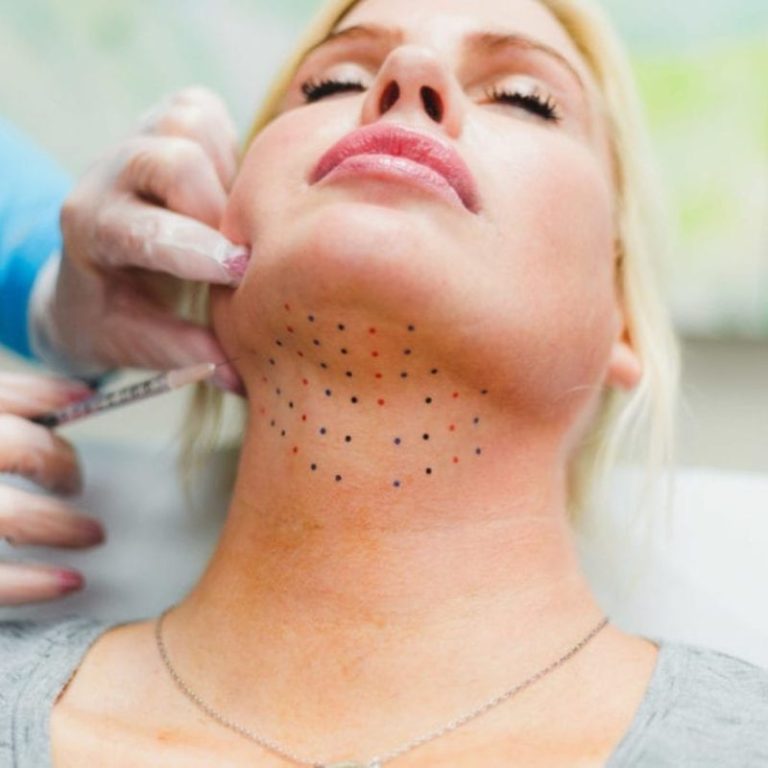 Kybella injections in Pahrump (double chin treatment)