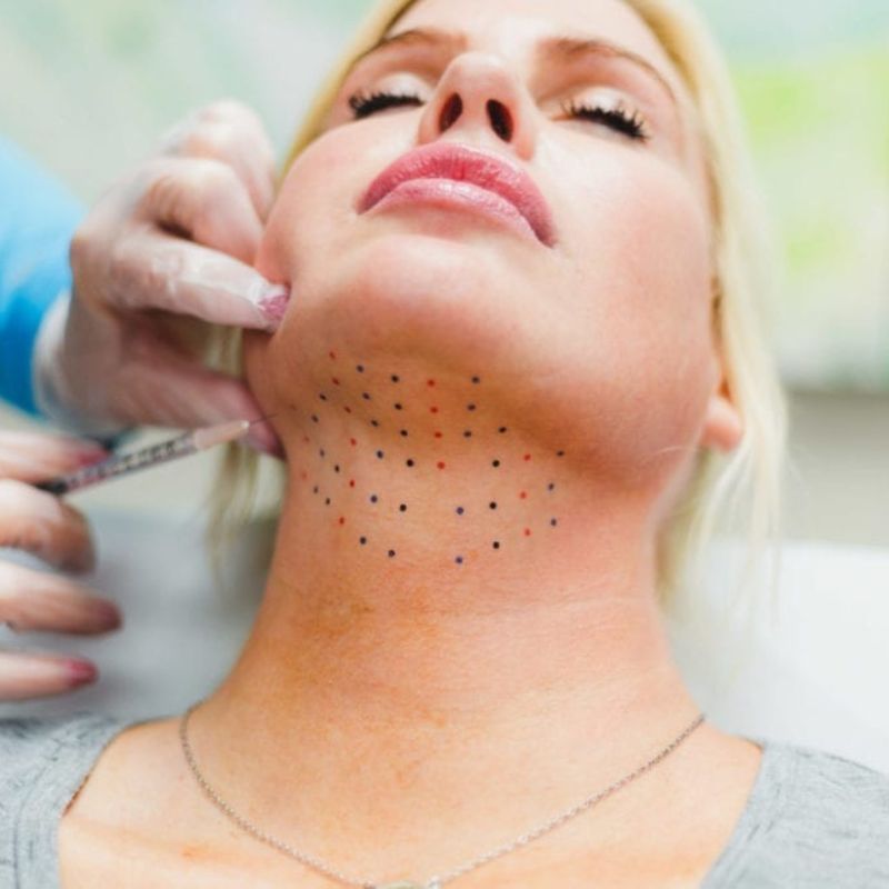 Kybella injections in Pahrump (double chin treatment)