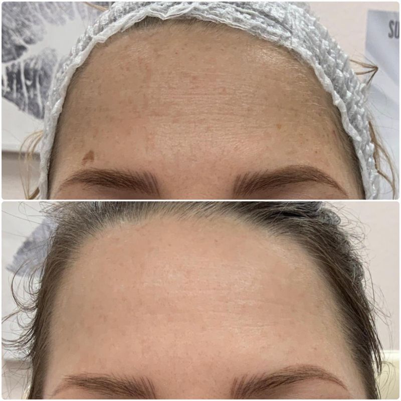 NanoLaser peel in Pahrump